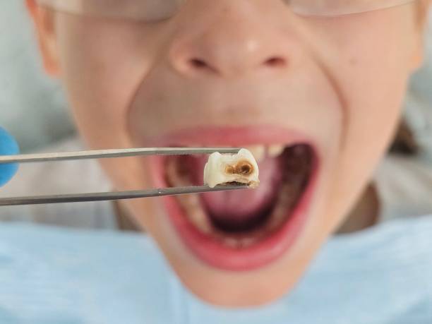 Best Emergency Denture Repair in Sawmills, NC