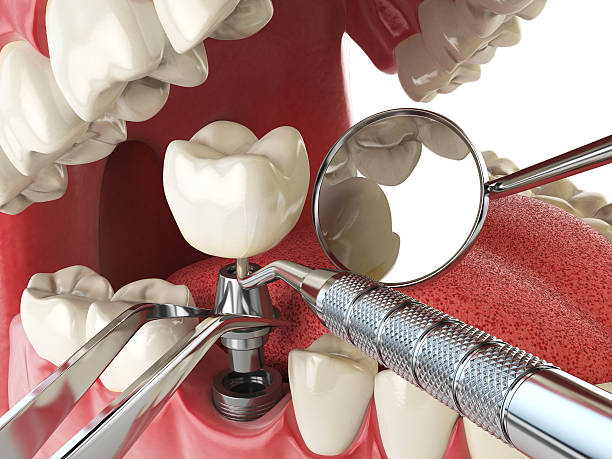 Best Urgent Care for Lost Fillings or Crowns in Sawmills, NC